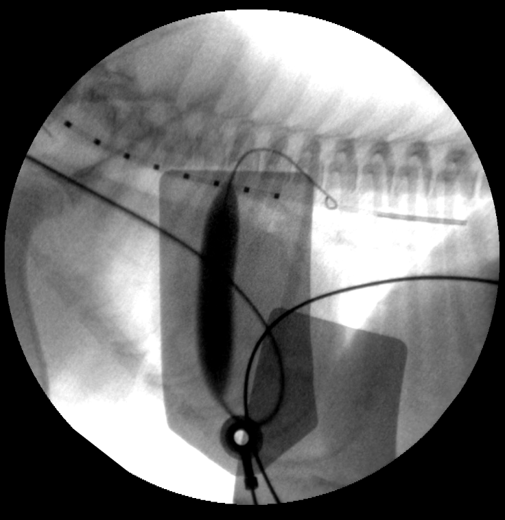 Balloon picture Cardiology procedure