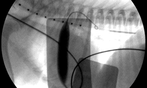 Cardiology procedure